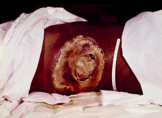 An Entamoeba histolytica infection that left the intestines and infected a patient's body tissues
