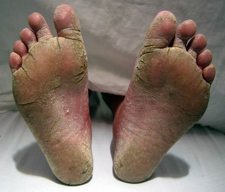A patient with Athlete's foot