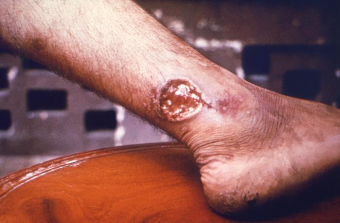Cutaneous leishmaniasis on a patient's ankle