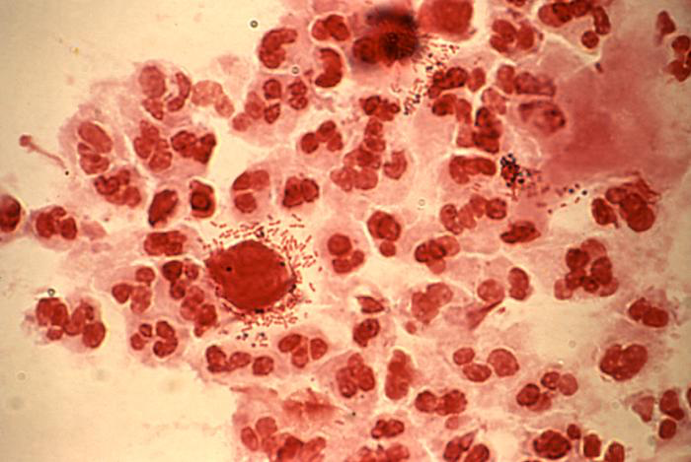 A gram-stained slide of urethral discharge showing both trichomonad organisms and rod-shaped bacteria 