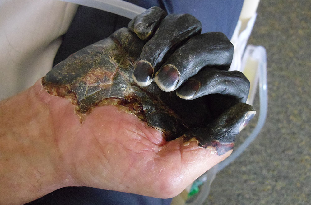 A decaying man's hand infected by Y. pestis.