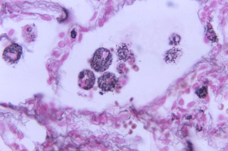 Stained slide of Cryptococcus in a lung lesion tissue specimen