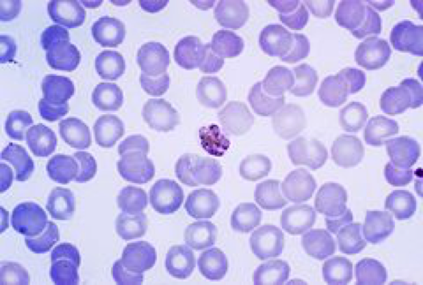 A Giesma-stained slide showing Plasmodium malariae surrounded by red blood cells