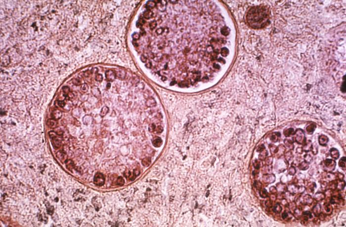 Microscopic slide of Coccidioides immitis, also known as Valley Fever