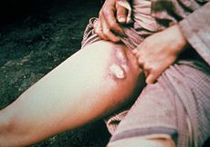 A swollen sore on the leg of a person infected with Y. pestis