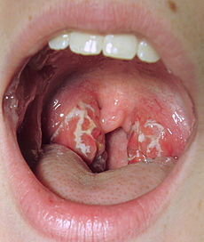 view of inside of mouth showing white pus of a streptococcus infection