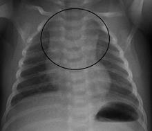 Chest x-ray showing the thymus gland.