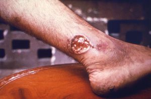 A large Leishmaniasis ulcer on a lower leg.