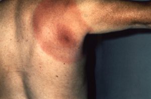 Large bulls-eye rash from Lyme's Disease on a shoulder and back.