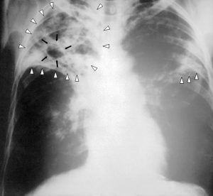 Chest x-ray of a TB patient.