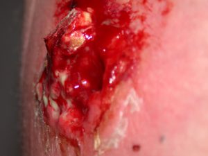 A bloody ruptured MRSA (Methicillin Resistant Staphylococcus aureus cyst.