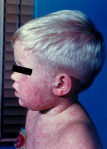 Child with measles rash