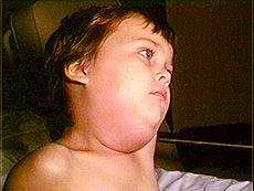Child with mumps with swollen lymph glands in neck
