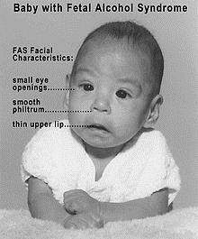 A baby with fetal alchohol syndrome