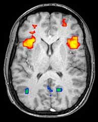 radiologic imaging of the brain and ganglia